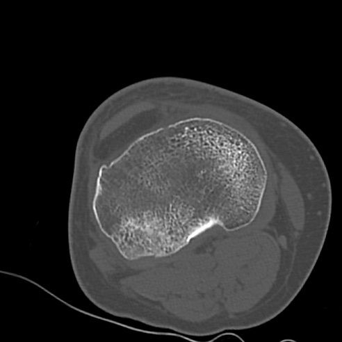 File:Anterior cruciate ligament avulsion fracture (Radiopaedia 58939-66194 Axial bone window 20).jpg
