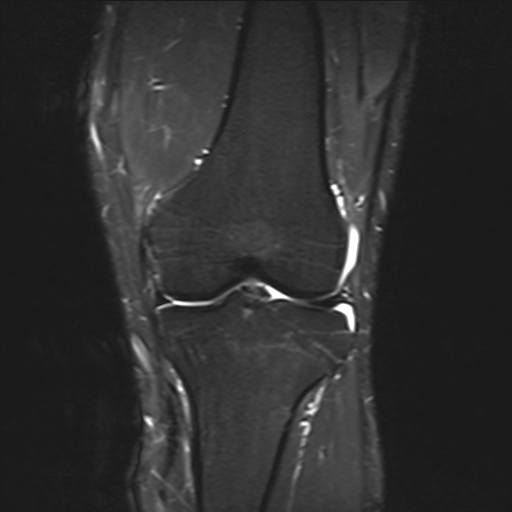 File:Anterior cruciate ligament full thickness tear (Radiopaedia 66268-75467 Coronal STIR 10).jpg