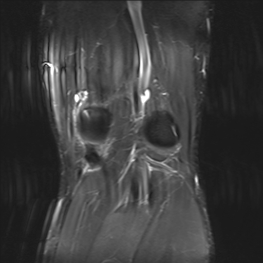 File:Anterior cruciate ligament full thickness tear (Radiopaedia 66268-75467 Coronal STIR 17).jpg