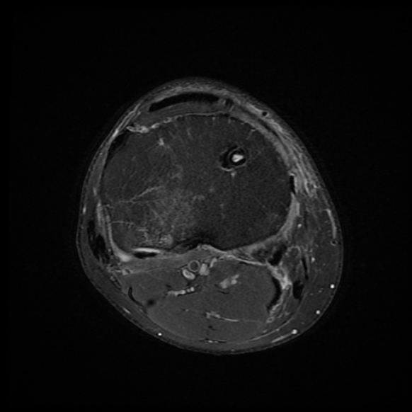 File:Anterior cruciate ligament graft tear and bucket-handle tear of medial meniscus (Radiopaedia 75867-87255 Axial PD fat sat 4).jpg
