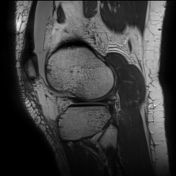Anterior cruciate ligament rupture with Segond fracture (Radiopaedia 69043-78806 Sagittal PD 141).jpg