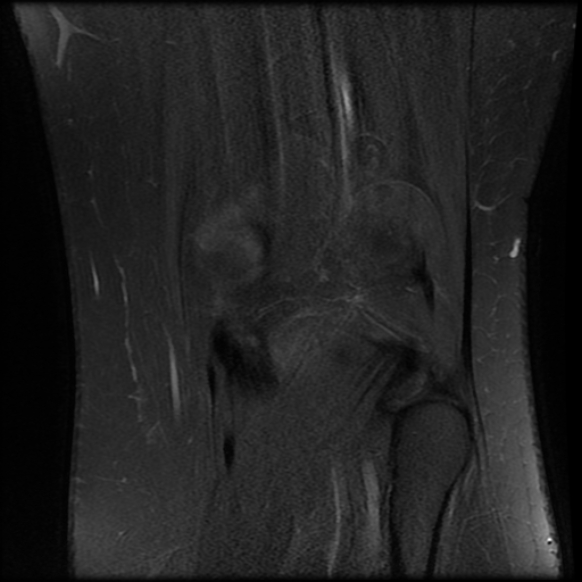 File:Anterior cruciate ligament tear, Wrisberg rip and bucket-handle tear of medial meniscus (Radiopaedia 75872-87266 Coronal PD fat sat 22).jpg