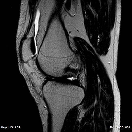File:Anterior cruciate ligament tear (Radiopaedia 70783-80964 Sagittal T2 13).jpg