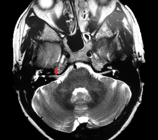 File:Anterior inferior cerebellar artery vascular loop - type III (Radiopaedia 26338-35609 Axial FIESTA 1).jpg