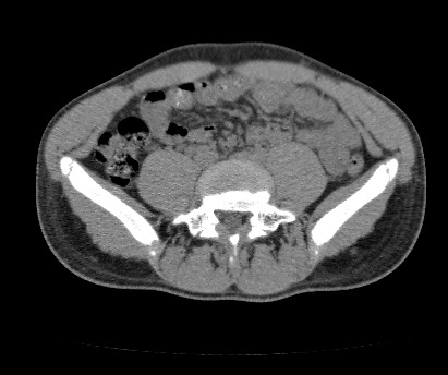 Anterior inferior iliac spine avulsion fracture (Radiopaedia 81312-94999 Axial non-contrast 17).jpg