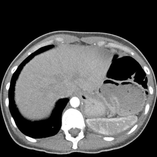 Anterior mediastinal lymphoma (Radiopaedia 29556-30061 C 49).jpg