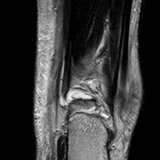 File:Anterior talofibular ligament rupture (Radiopaedia 15831-15484 Coronal T2 18).jpg