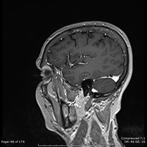 File:Anterior temporal lobe perivascular space (Radiopaedia 88283-104914 Sagittal T1 C+ 7).jpg