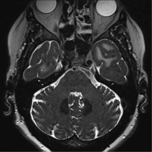 Anterior temporal pole cysts (Radiopaedia 46629-51102 Axial 12).png