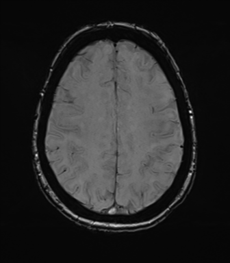 Anterior temporal pole cysts (Radiopaedia 46629-51102 Axial SWI 63).png