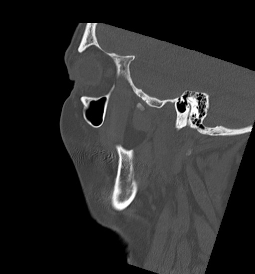 Anterior temporomandibular joint dislocation (Radiopaedia 59430-66784 B 12).jpg