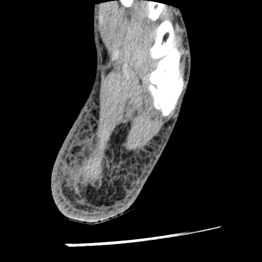 File:Anterior tibial artery false aneurysm (Radiopaedia 88984-105809 A 228).jpg