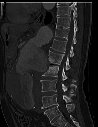 File:Anterior vertebral scalloping (abdominal aortic aneurysm) (Radiopaedia 66744-76067 Sagittal bone window 43).jpg