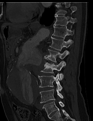File:Anterior vertebral scalloping (abdominal aortic aneurysm) (Radiopaedia 66744-76067 Sagittal bone window 52).jpg