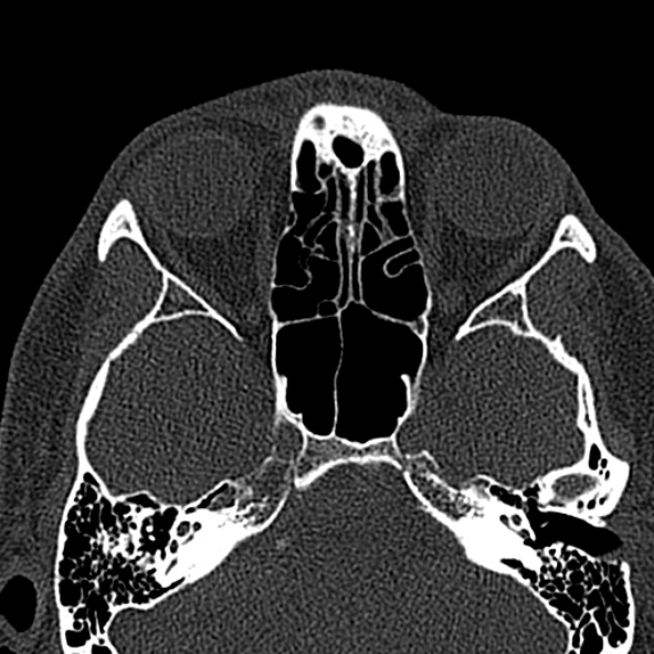 Antrochoanal polyp (Radiopaedia 30002-30554 Axial bone window 39).jpg