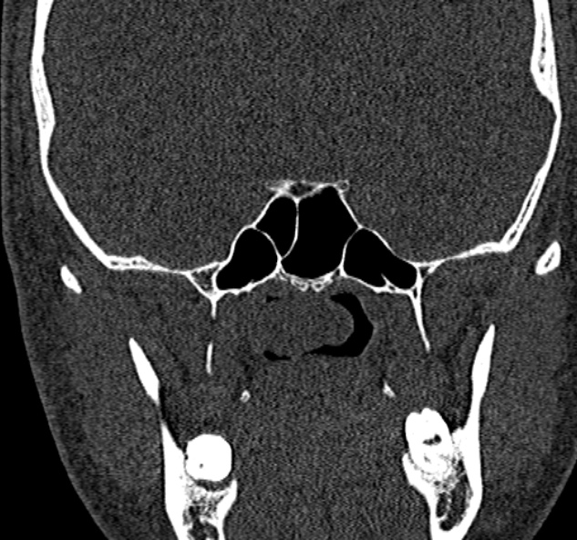 Antrochoanal polyp (Radiopaedia 30002-30554 Coronal bone window 66).jpg