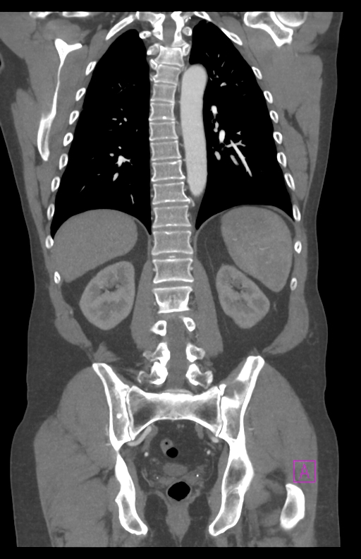 Aortectomy and axillary-bifemoral bypass (Radiopaedia 28303-28545 C 64).jpg