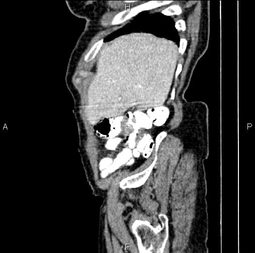 Aortic aneurysm and Lemmel syndrome (Radiopaedia 86499-102554 D 10).jpg