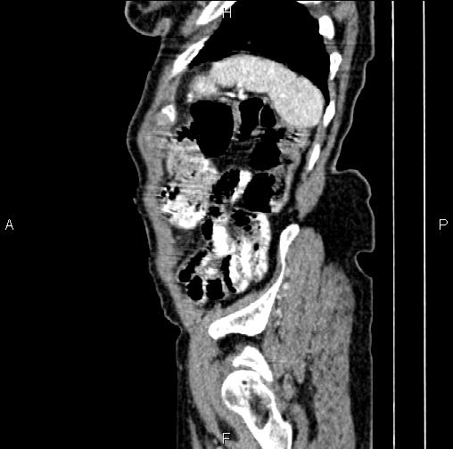 File:Aortic aneurysm and Lemmel syndrome (Radiopaedia 86499-102554 D 79).jpg