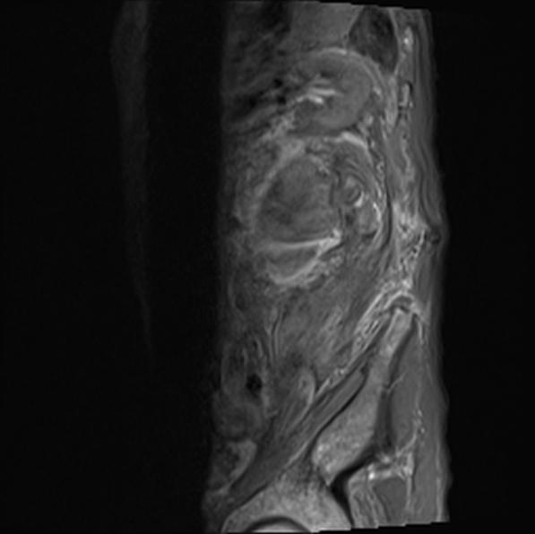 File:Aortic aneurysm with spinal destruction (Radiopaedia 42301-45409 Sagittal T1 fat sat 39).jpg