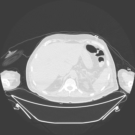 Aortic arch aneurysm (Radiopaedia 84109-99365 Axial lung window 263).jpg