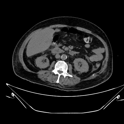 Aortic arch aneurysm (Radiopaedia 84109-99365 Axial non-contrast 349).jpg