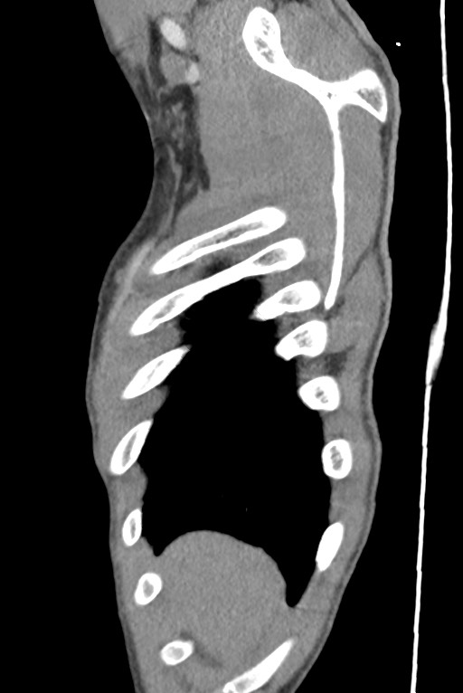 Aortic coarctation with aneurysm (Radiopaedia 74818-85828 B 21).jpg
