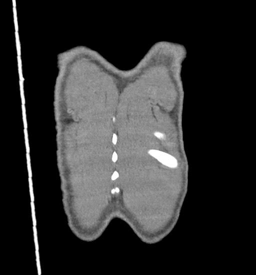 Aortic coarctation with aneurysm (Radiopaedia 74818-85828 C 116).jpg