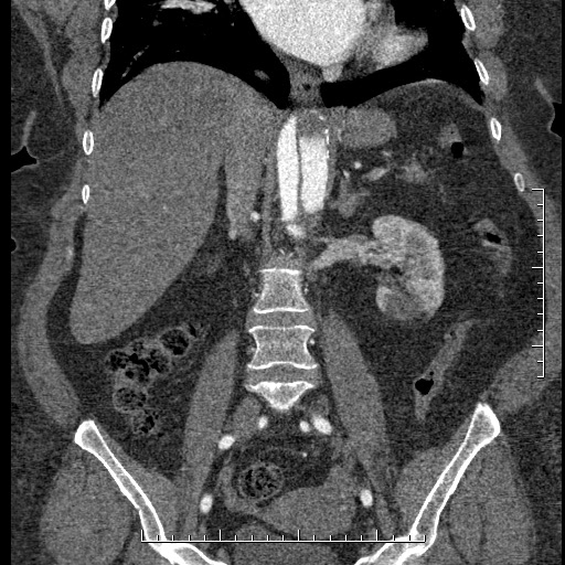 File:Aortic dissection- Stanford A (Radiopaedia 35729-37268 F 26).jpg