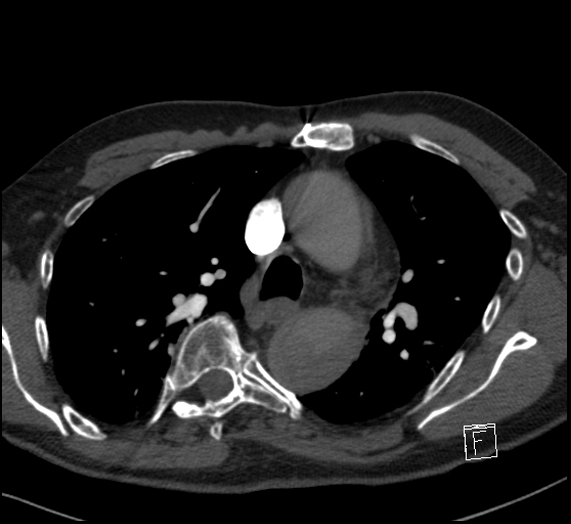 File:Aortic dissection (CTPA) (Radiopaedia 75506-86751 Axial C+ CTPA 51).jpg