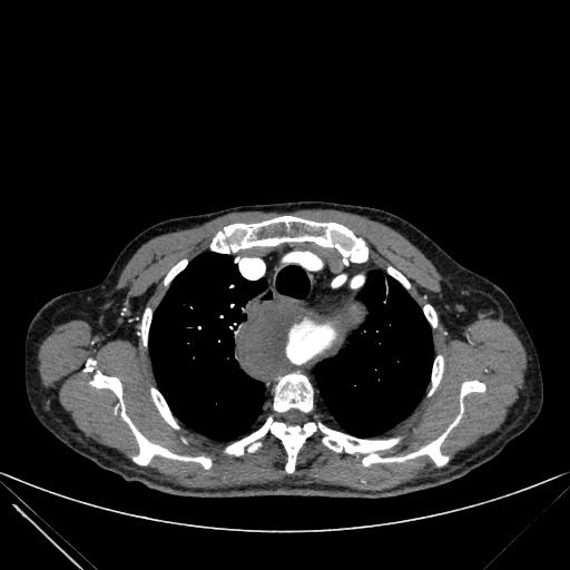 Aortic dissection (Radiopaedia 27466-27665 C+ arterial phase 17).jpg