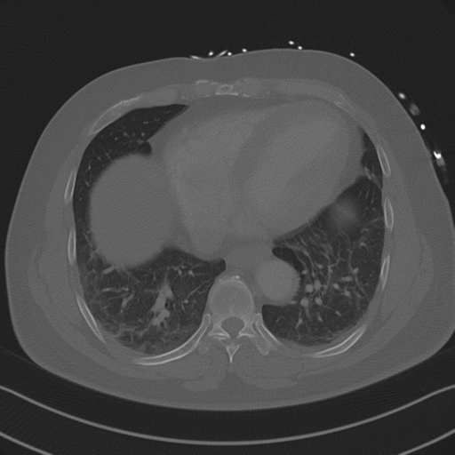 Aortic dissection (Radiopaedia 50763-56234 Axial bone window 73).png