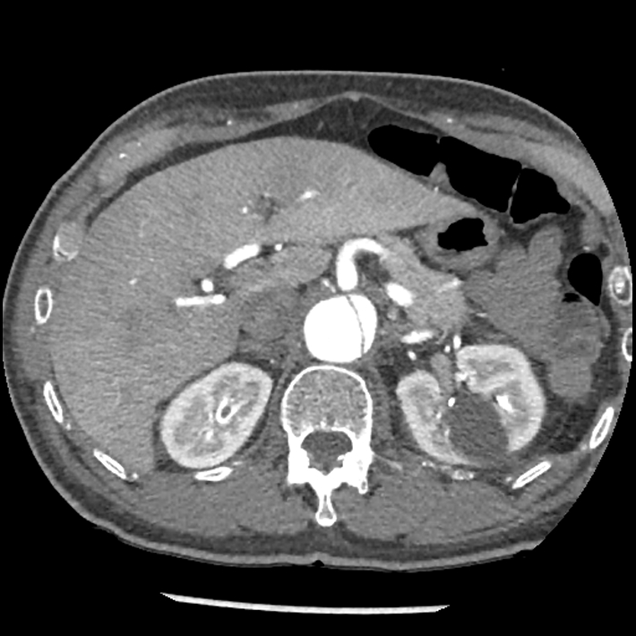 Aortic dissection - DeBakey Type I-Stanford A (Radiopaedia 79863-93115 A 42).jpg