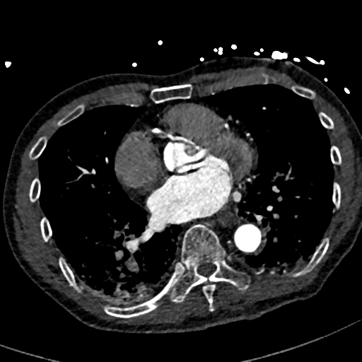 File:Aortic dissection - DeBakey type II (Radiopaedia 64302-73082 A 56).png