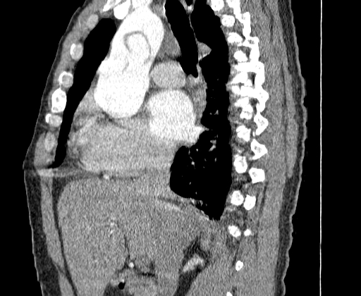 Aortic dissection - Stanford A -DeBakey I (Radiopaedia 28339-28587 C 12).jpg