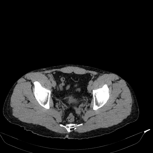 Aortic dissection - Stanford type A (Radiopaedia 83418-98500 Axial non-contrast 85).jpg