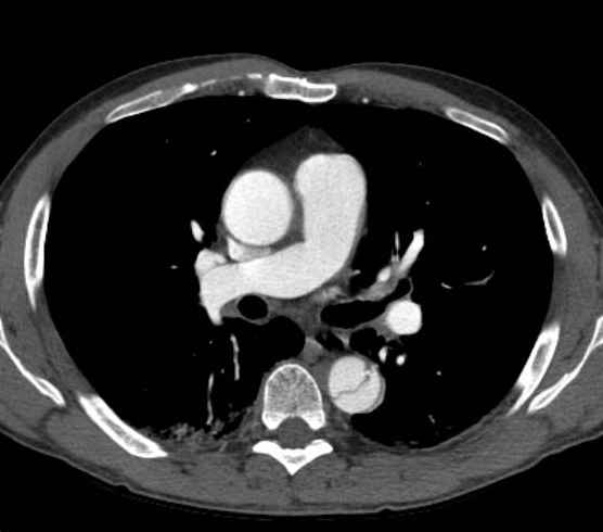 File:Aortic dissection - Stanford type B (Radiopaedia 73648-84437 A 47).jpg