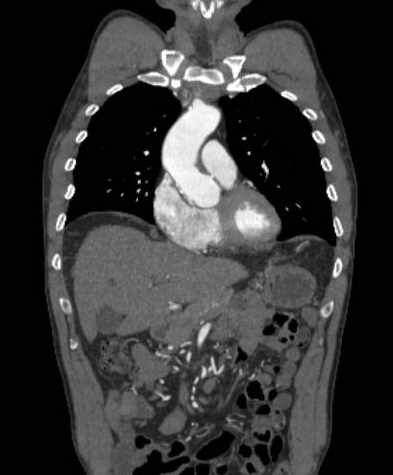 File:Aortic dissection - Stanford type B (Radiopaedia 73648-84437 B 41).jpg