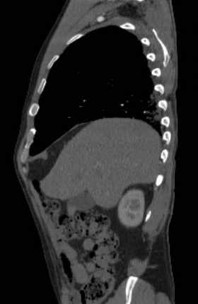 File:Aortic dissection - Stanford type B (Radiopaedia 73648-84437 C 123).jpg