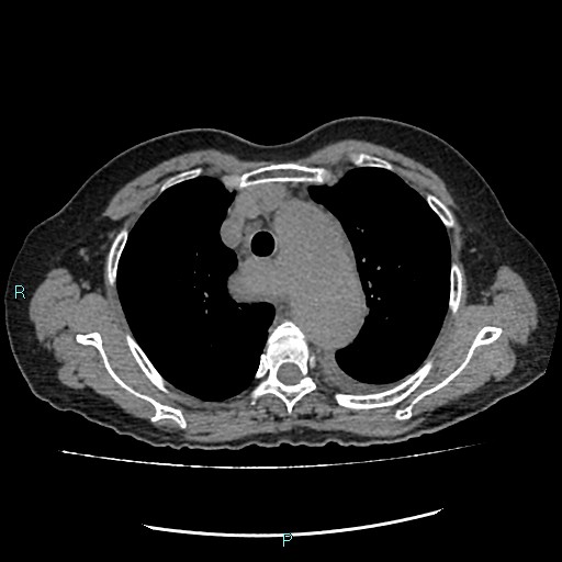 File:Aortic dissection extended to lusory artery (Radiopaedia 43686-47136 Axial non-contrast 8).jpg