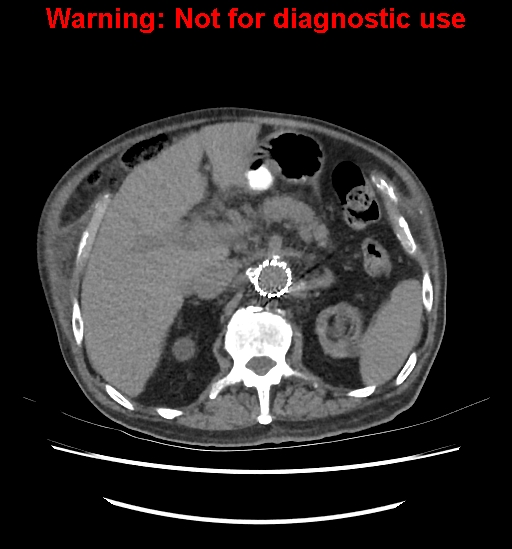 File:Aortic graft infection (Radiopaedia 44979-48907 Axial non-contrast 36).jpg
