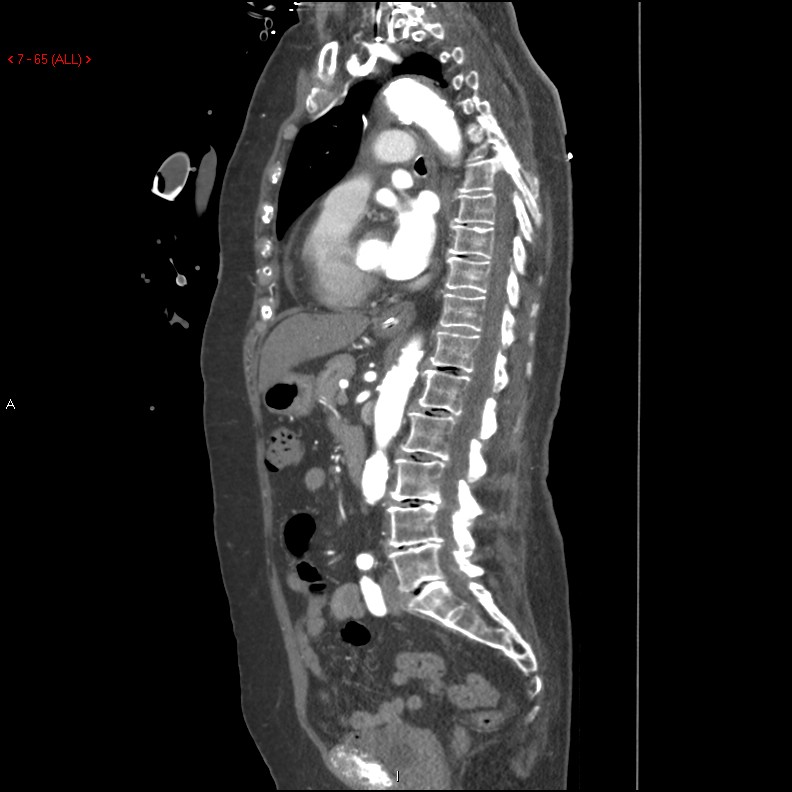Aortic intramural hematoma (Radiopaedia 27746-28001 C 34).jpg