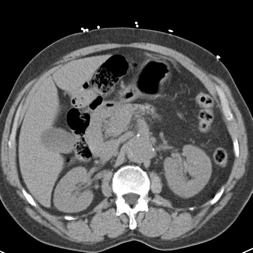 Aortic intramural hematoma (Radiopaedia 31139-31838 Axial non-contrast 58).jpg