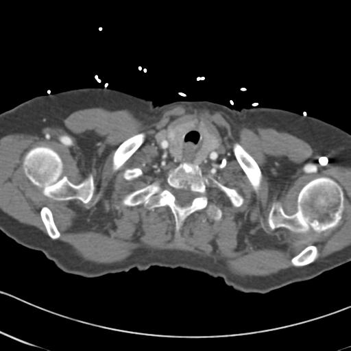 Aortic intramural hematoma from penetrating atherosclerotic ulcer (Radiopaedia 31137-31836 A 1).jpg