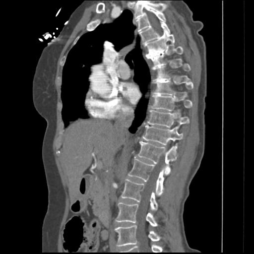 File:Aortic intramural hematoma from penetrating atherosclerotic ulcer (Radiopaedia 31137-31836 B 26).jpg