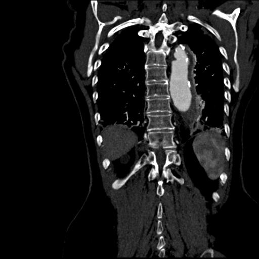 Aortic intramural hematoma from penetrating atherosclerotic ulcer (Radiopaedia 31137-31836 C 54).jpg