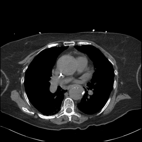 Aortic intramural hematoma with dissection and intramural blood pool (Radiopaedia 77373-89491 Axial non-contrast 49).jpg