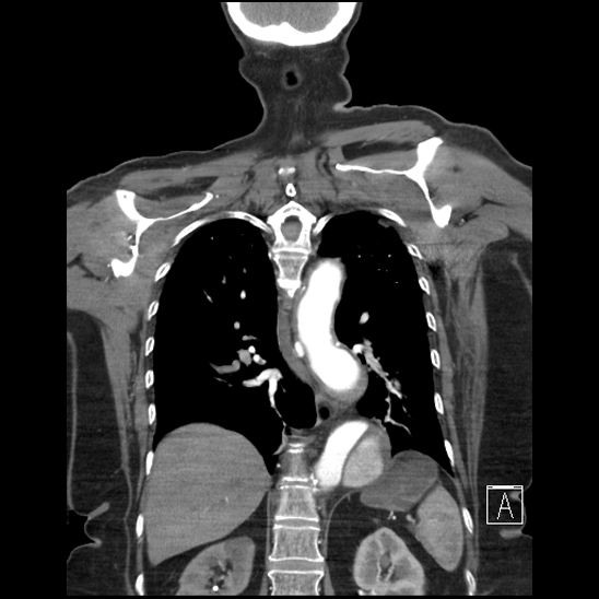Aortic intramural hematoma with dissection and intramural blood pool (Radiopaedia 77373-89491 C 45).jpg