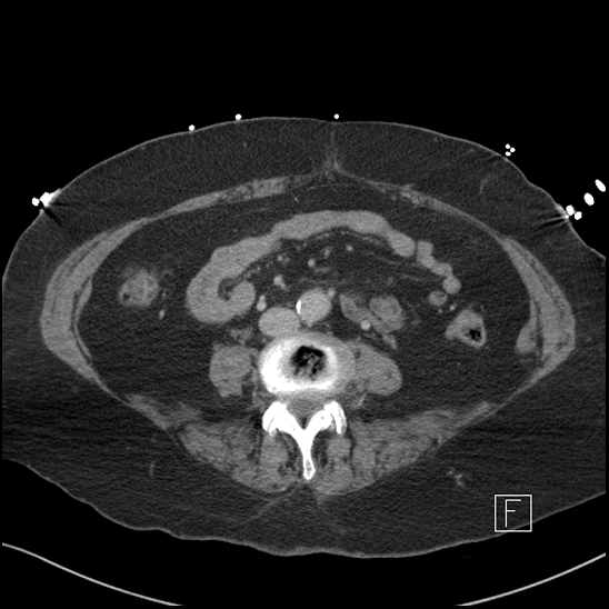 File:Aortic intramural hematoma with dissection and intramural blood pool (Radiopaedia 77373-89491 E 52).jpg