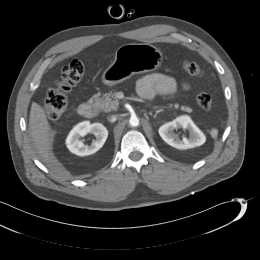 Aortic transection, diaphragmatic rupture and hemoperitoneum in a complex multitrauma patient (Radiopaedia 31701-32622 A 99).jpg